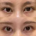目尻切開 / タレ目形成・グラマラスライン（切開） eクリニック 金沢本院 BEFORE サムネイル用