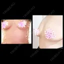 豊胸（シリコンバッグ） 湘南美容クリニック 名古屋栄院 BEFORE サムネイル用