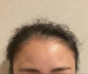 アートメイク（ヘアライン） トイトイトイクリニック 池袋院 BEFORE サムネイル用