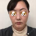 ハイフ（顔） オーキッド美容クリニック東京御徒町 BEFORE サムネイル用