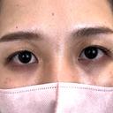 二重埋没 NARU Beauty Clinic 【ナルクリ】 BEFORE サムネイル用