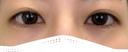 二重埋没 NARU Beauty Clinic 【ナルクリ】 BEFORE サムネイル用