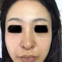 ピコレーザートーニング（美白・肝斑） ルラ美容クリニック 高田馬場院 BEFORE サムネイル用