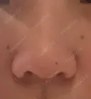 鼻中隔延長（切開） / 鼻尖縮小 ビスポーククリニック 福岡院 BEFORE サムネイル用