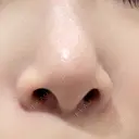 ピーリング（ニキビ・毛穴） / 毛穴洗浄（ハイドラフェイシャルなど） 表参道メディカルクリニック 銀座院 BEFORE サムネイル用