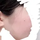 ほくろ・いぼ切除（肌） ニューセンス皮膚科クリニック BEFORE サムネイル用