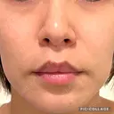 口角挙上 ヴェリテクリニック 名古屋院 BEFORE サムネイル用