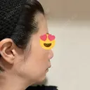 ヒアルロン酸注入（頬） BRIGHTS beauty clinic BEFORE サムネイル用