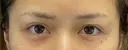 二重埋没 BELINDA CLINIC（ベリンダクリニック）新宿院 BEFORE サムネイル用