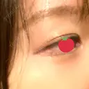 アートメイク（ほくろ） oneUPclinic BEFORE サムネイル用