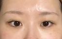 二重埋没 フローラクリニック BEFORE サムネイル用