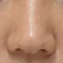 小鼻縮小（切開） GLANZ CLINIC BEFORE サムネイル用