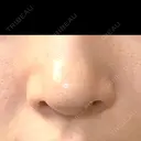 小鼻縮小（切開） 山本クリニック BEFORE サムネイル用