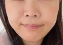 小鼻縮小（非切開） AI Beauty Clinic （エーアイ美容クリニック） BEFORE サムネイル用