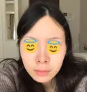 鼻尖形成（切開） / 軟骨移植 JUN CLINIC BEFORE サムネイル用
