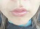 ヒアルロン酸注入（唇） / ボトックス（口角） グランメドクリニック茨木 BEFORE サムネイル用
