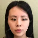 隆鼻術 / 鼻尖形成（切開） / 鼻中隔延長（切開） / 軟骨移植 / 骨切幅寄せ / 斜鼻修正 / 鼻修正 / 鼻尖縮小 GNG美容外科 BEFORE サムネイル用