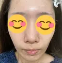 ヴェルヴェットスキン 新宿西口TAKUMI美容クリニック（シンジュクニシグチタクミビヨウクリニック) BEFORE サムネイル用
