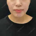 糸リフト / バッカルファット除去 / 脂肪吸引（顔） 湘南美容クリニック 京都院 BEFORE サムネイル用