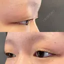 二重埋没 / 上まぶたの脂肪取り X CLINIC 福岡天神院 BEFORE サムネイル用
