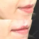 ヒアルロン酸注入（唇） / ボトックス（口角） / リジュラン id美容クリニック 銀座院 BEFORE サムネイル用