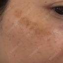 シミ取りレーザー Jスキンクリニック 【J-SKIN clinic】 BEFORE サムネイル用