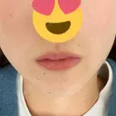 ボトックス（あご） / ヒアルロン酸注入（あご） ルラ美容クリニック 名古屋本院 BEFORE サムネイル用