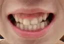 ガミースマイル手術 / その他（審美歯科/矯正歯科） / 矯正（ワイヤー） / セラミック 東京銀座A CLINIC デンタル BEFORE サムネイル用
