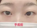 二重埋没 / 上まぶたの脂肪取り 湘南美容クリニック 奈良院 BEFORE サムネイル用