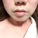 糸リフト / ジョールファット除去 ルラ美容クリニック 大阪本院 BEFORE サムネイル用