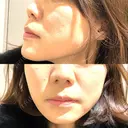 ボトックス（エラ・小顔） TCB東京中央美容外科 京都駅前院 BEFORE サムネイル用