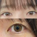 二重埋没 よだ形成外科クリニック BEFORE サムネイル用