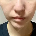 糸リフト / ジョールファット除去 高崎美容クリニック BEFORE サムネイル用