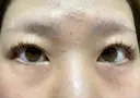 眼瞼下垂（切開） ステラ ロサ クリニック BEFORE サムネイル用