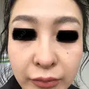 ピコレーザートーニング（美白・肝斑） ルラ美容クリニック 高田馬場院 BEFORE サムネイル用