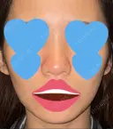 隆鼻術 / 鼻尖形成（切開） / 糸リフト / 軟骨移植 / ヒアルロン酸注入（頬） ASTRA BEAUTY CLINIC BEFORE サムネイル用
