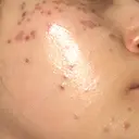 シミ取りレーザー / ピコスポット Olino美容外科・美容皮膚科 BEFORE サムネイル用