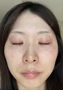 ピコレーザートーニング（美白・肝斑） PTクリニック六本木 BEFORE サムネイル用