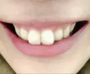 ガミースマイル手術 / その他（審美歯科/矯正歯科） / その他（口元） 有楽町美容外科クリニック BEFORE サムネイル用