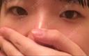 二重切開 / 上まぶたの脂肪取り 聖心美容クリニック 横浜院 BEFORE サムネイル用