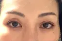二重埋没 / 眼瞼下垂（非切開） フェアクリニック川口 BEFORE サムネイル用