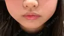ボトックス（エラ・小顔） 湘南美容クリニック 名古屋栄院 BEFORE サムネイル用