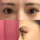 目頭切開 / 目尻切開 / 目尻靭帯移動 DIVINE（ディバイン）整形外科 BEFORE サムネイル用