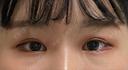 ヒアルロン酸注入（涙袋） プリモ麻布十番クリニック BEFORE サムネイル用