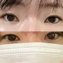 二重切開 / 目頭切開 聖心美容クリニック 札幌院 BEFORE サムネイル用
