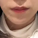 ヒアルロン酸注入（あご） ASTRA BEAUTY CLINIC BEFORE サムネイル用