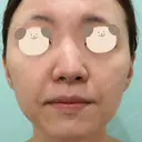 鼻尖形成（切開） / 小鼻縮小（切開） / 軟骨移植 / 骨切幅寄せ / 小鼻縮小（非切開） WOM CLINIC GINZA （ワム クリニック ギンザ） BEFORE サムネイル用