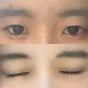 二重埋没 よだ形成外科クリニック BEFORE サムネイル用