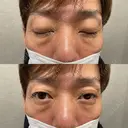 下まぶたの脂肪取り 東郷美容形成外科　福岡 BEFORE サムネイル用