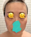 糸リフト / クマ治療 / 脂肪吸引（顔） / 脂肪注入（額） / ヒアルロン酸注入（あご） / ボトックス（エラ・小顔） / 脂肪注入（輪郭） / ボトックス（額） X CLINIC 福岡天神院 BEFORE サムネイル用